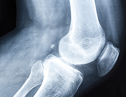 An x-ray of a knee joint. 