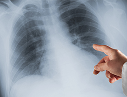 A person pointing at a x-ray of a chest.